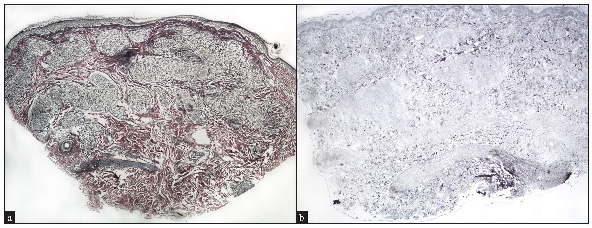 (a) Preservation of reticulin fibers within well-circumscribed granulomas, indicating reticulin-rich sarcoidal granulomas (Reticulin stain, 20x). (b) Absence of reticulin fibers within well-circumscribed granulomas, indicating reticulin-poor sarcoidal granulomas (Reticulin stain, 40x).