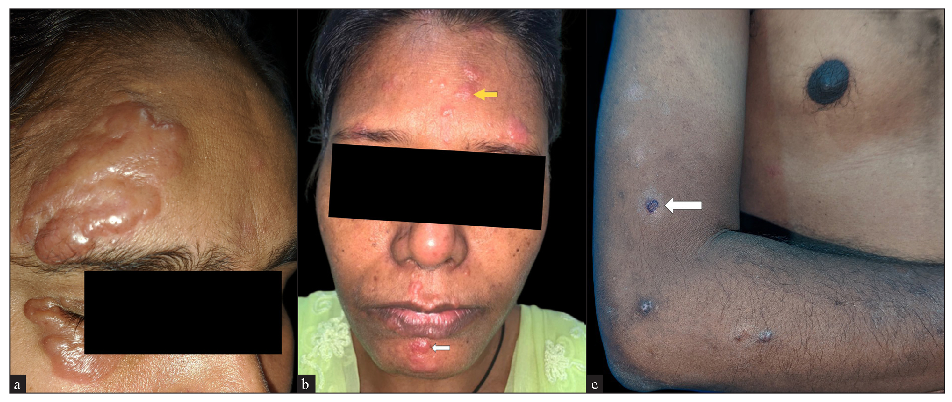 (a) Oedematous shiny skin-coloured plaques overlying scars from a previous injury. (b) Multiple erythematous papules (white arrow) and plaques (yellow arrow) on the face. (c) Discrete erythematous to brown papules and plaques with a perilesional hypopigmented halo (white arrow).