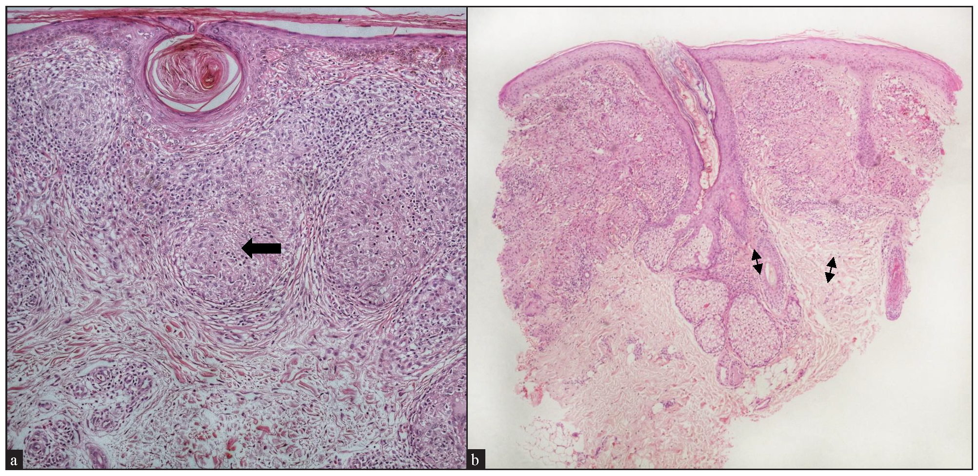 Epidermal changes: (a) Cutaneous sarcoidosis showing prominent follicular plugging (black arrow) (Haematoxylin and eosin, 100x). (b) Cutaneous sarcoidosis showing a narrow grenz zone (double-headed arrows) (Haematoxylin and eosin, 40x).