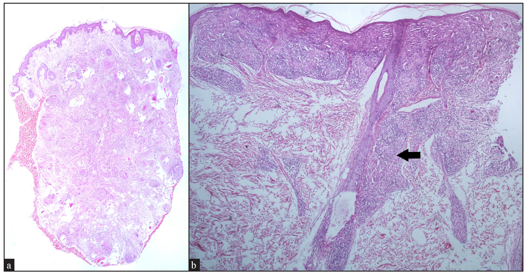 (a) Well-circumscribed to coalescent granulomas present throughout the dermis with subcutaneous extension (Haematoxylin and eosin, 20x). (b) Band-like distribution of granuloma in the upper dermis with perifollicular extension (black arrow) (Haematoxylin and eosin, 40x).