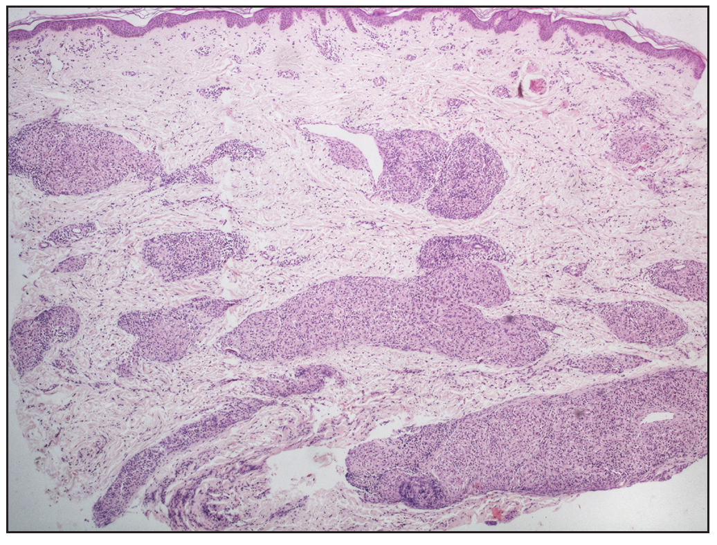 Sarcoidal granulomas oriented in leprosy pattern, showing superficial and deep, discrete, oval, oblong, and curvilinear well-circumscribed configuration of granulomas (Haematoxylin and eosin, 40x).