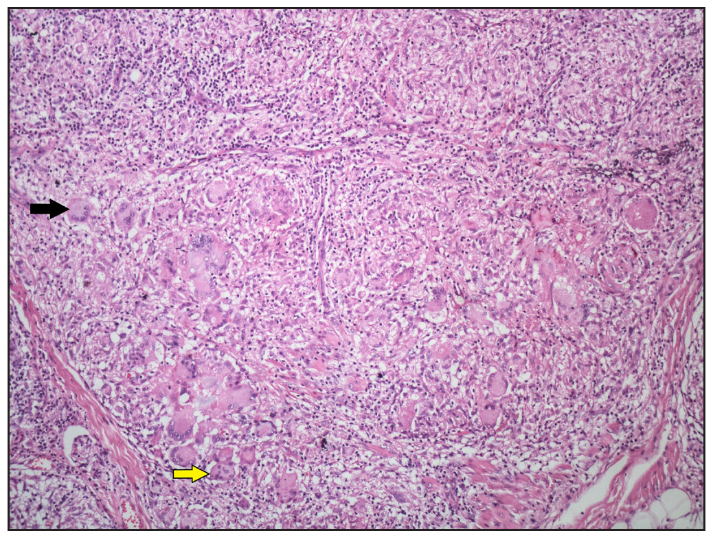 Numerous Langhans-type giant cells (black arrow) and foreign body giant cells (yellow arrow) present within the sarcoidal granulomas (Haematoxylin and eosin, 100x).