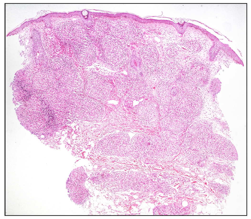 Pandermal distribution of discrete granulomas in the superficial, mid, and deep dermis with surrounding pauci-cellular infiltrate (Haematoxylin and eosin 40x).