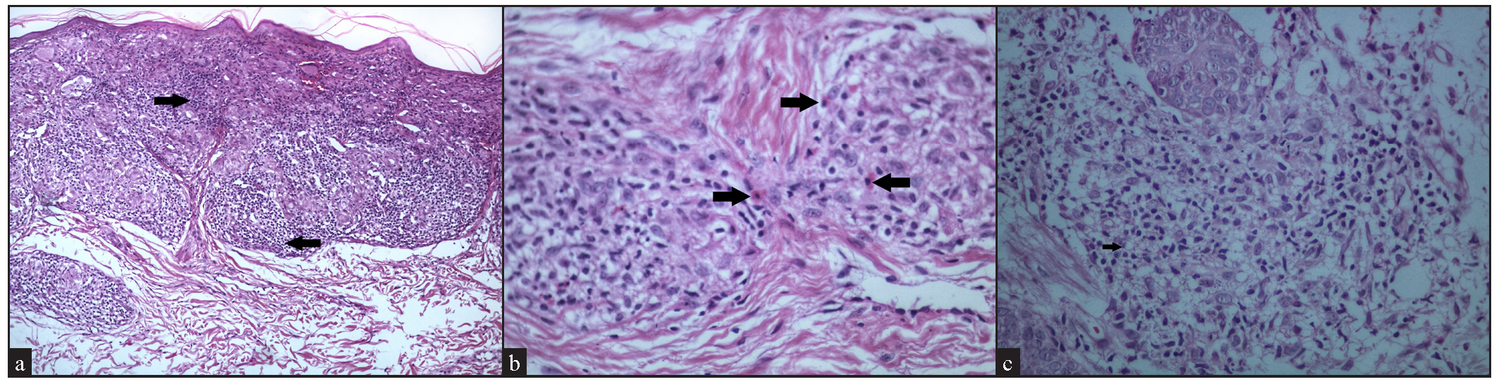 (a) Dense lymphocytic infiltrate (black arrows) around the sarcoidal granulomas (Haematoxylin and eosin, 100x). (b) Presence of eosinophils (black arrows) among the granulomatous infiltrate (Haematoxylin and eosin, 400x). (c) Presence of foamy histiocytes (arrow) within the granulomatous infiltrate (Haematoxylin and eosin, 400x).