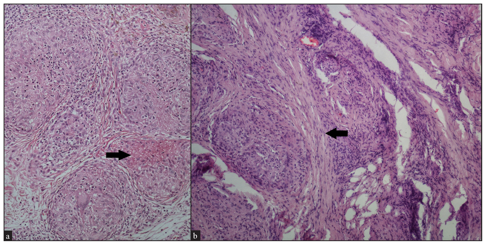 (a) Fibrinoid type of necrosis (arrow) seen in the granuloma (Haematoxylin and eosin, 100x). (b) Fibrosis (black arrow) encircling the granuloma (Haematoxylin and eosin, 100x).