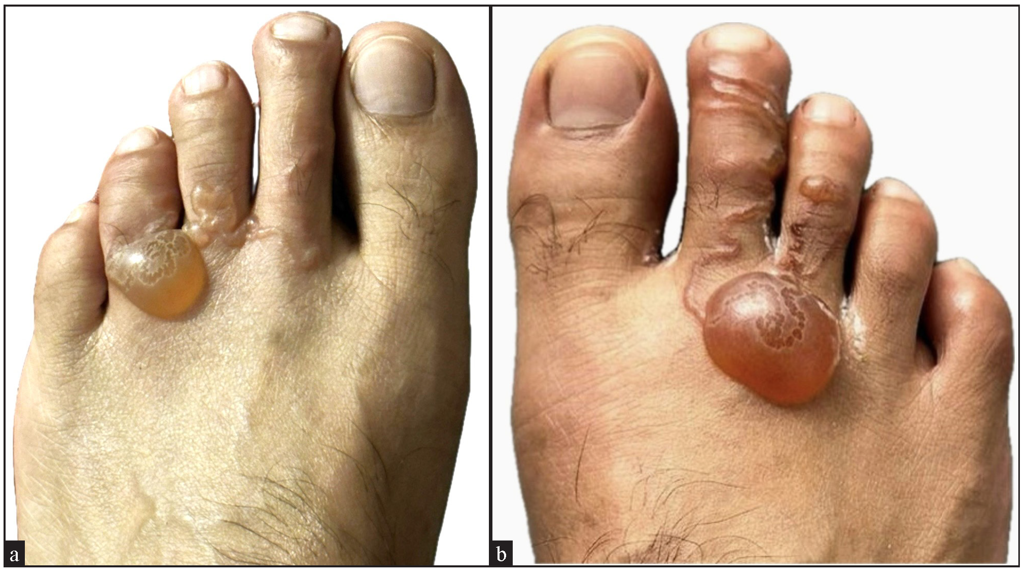 Erythematous, serpiginous tracts with tense bullae suggestive of bullous cutaneous larva migrans over both feet.