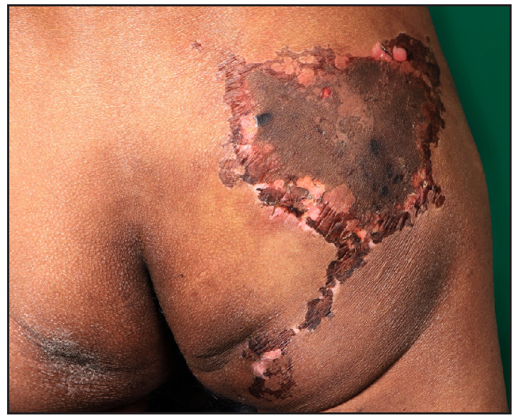 Superficial necrosis and peeling on day 7 of triple therapy.