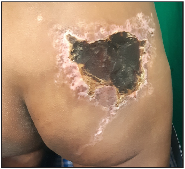 Follow-up after 2 months. The necrotic area at the centre of the plaque has become well-demarcated with eschar.