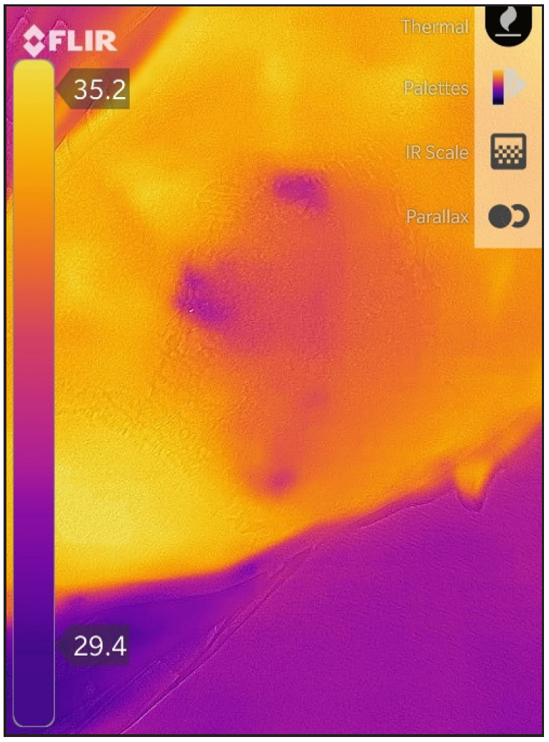 Thermography on day 7 showed a decrease in the size of the cold spot (temperature gradient- 1.59°C)