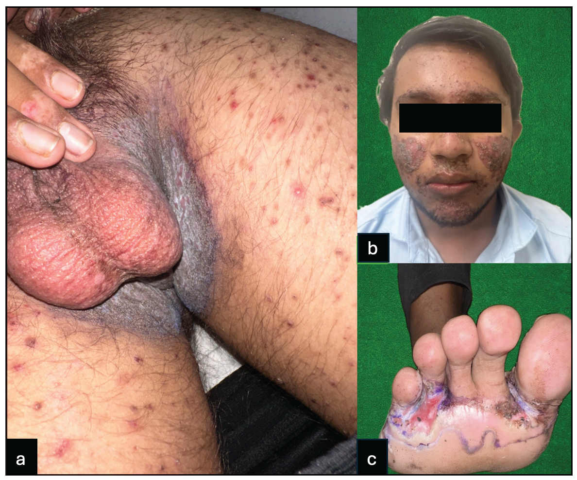 (a) Multiple erythematous plaques with serous discharge present in the groin folds, (b) Multiple crusted plaques present over malar area and perioral region, (c) Erythematous plaque with serous discharge present over the web spaces.