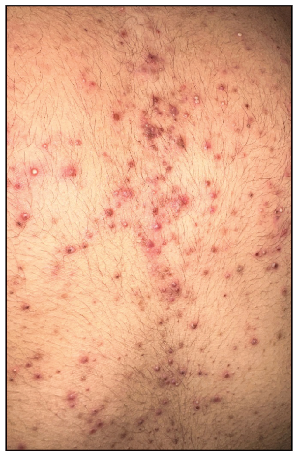 Multiple vesicular lesions present in the anterior aspect of the trunk.