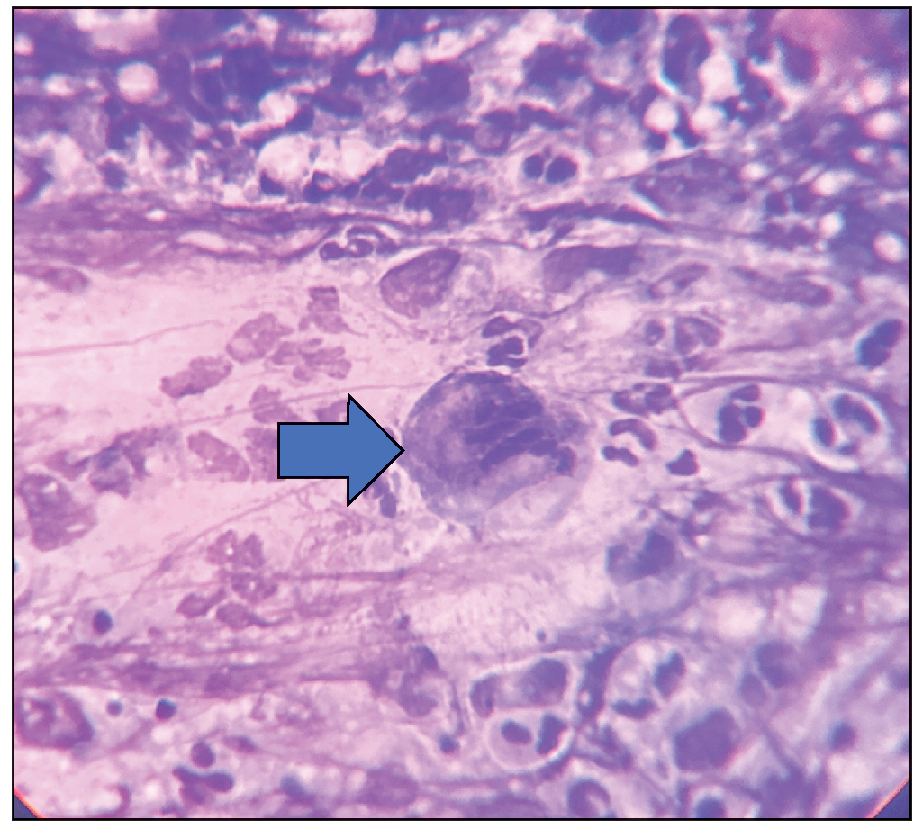 Multinucleated giant cells seen as highlighted by blue arrow (Giemsa stain, 40x).