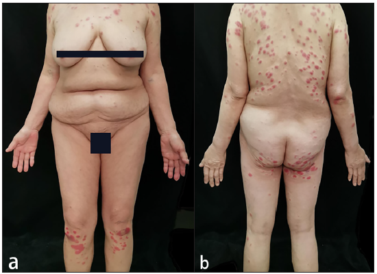 (a) Infiltrated erythematous plaques on face and legs, and multiple erythematous nodules on trunk and limbs. (b) Multiple erythematous nodules and infiltrated erythematous plaques on trunk and limbs.