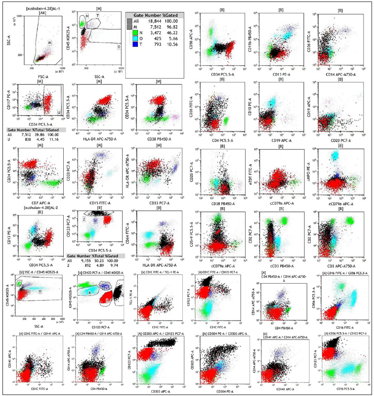 Flow cytometry of bone marrow identified CD34+, CD123+, Human leukocyte antigen (locus) DR+, nTDT+, CD303+, CD304+blasts.