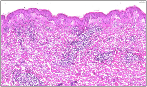 A clear grenz zone between epidermis and dermis (Haematoxylin and eosin, 100x).