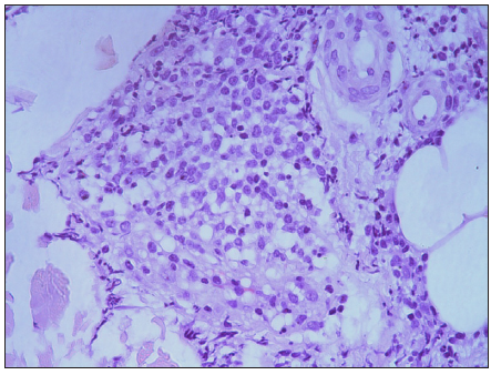 The extensive infiltration of neoplastic cells which demonstrated nuclear atypia and immature nuclear chromatin pattern with occasional nucleoli in the entire dermis (Haematoxylin and eosin, 400x).