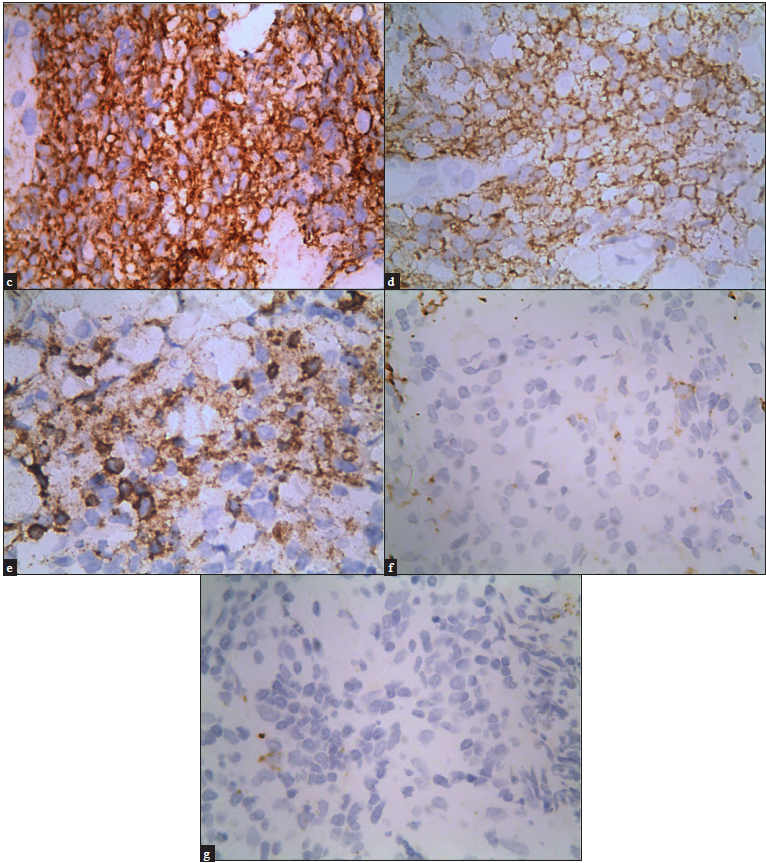 Immunohistochemical staining demonstrated that the tumour cells were diffusely positive for (c) CD38, 400x, (d) CD123, 400x, (e) CD56, 400x, and negative for (f) CD34, 400x, and (g) anti-myeloperoxidase, 400x.