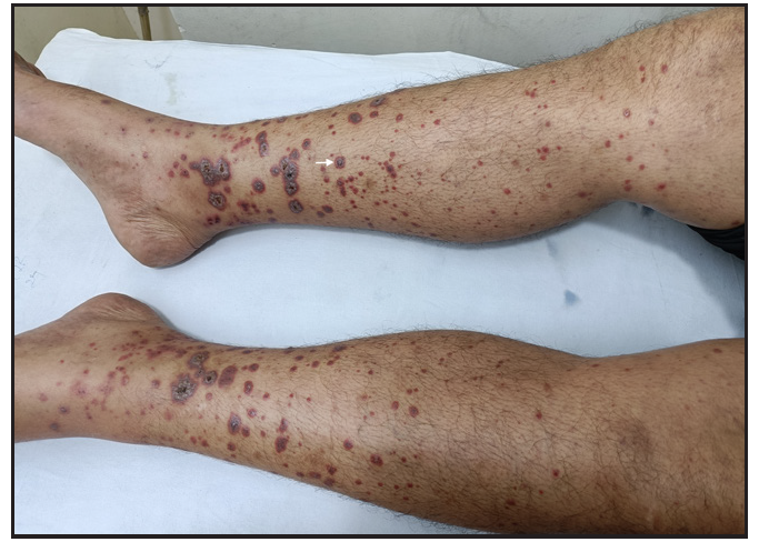 IgA Vasculitis in adults: Importance of recognising diverse cutaneous ...