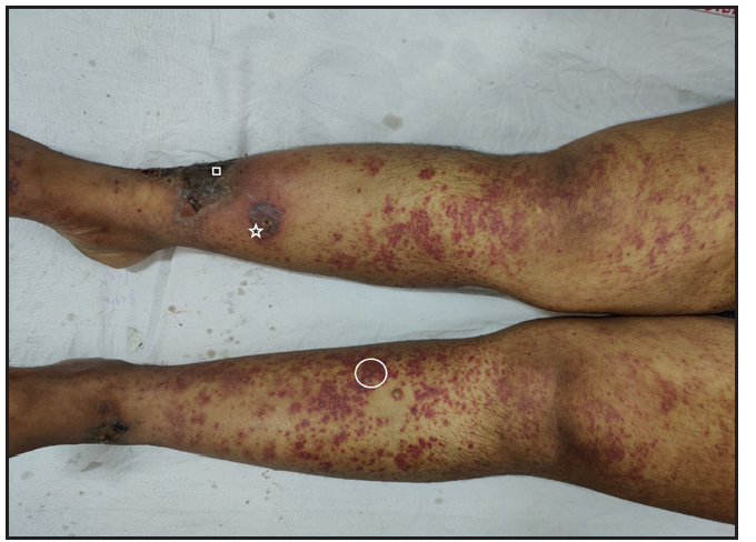 Purpuric macules and papules over both lower limbs (white circle), dusky hemorrhagic lesions (white star), and necrotic lesions (white square) in case 2.