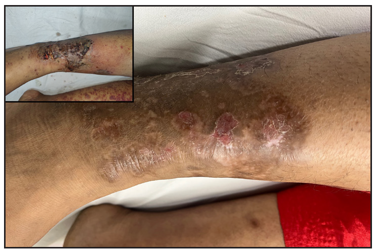 Healing of necrotic lesions with scarring and dyspigmentation in patient 2 after 3 months of cyclosporine (inset shows the presence of necrotic lesion at onset).