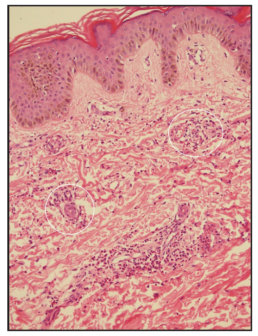 Skin biopsy in patient 3 showing dermal oedema, red cell extravasation, endothelial swelling, and leukocytoclasia (white circle, Haematoxylin and eosin, 200x).