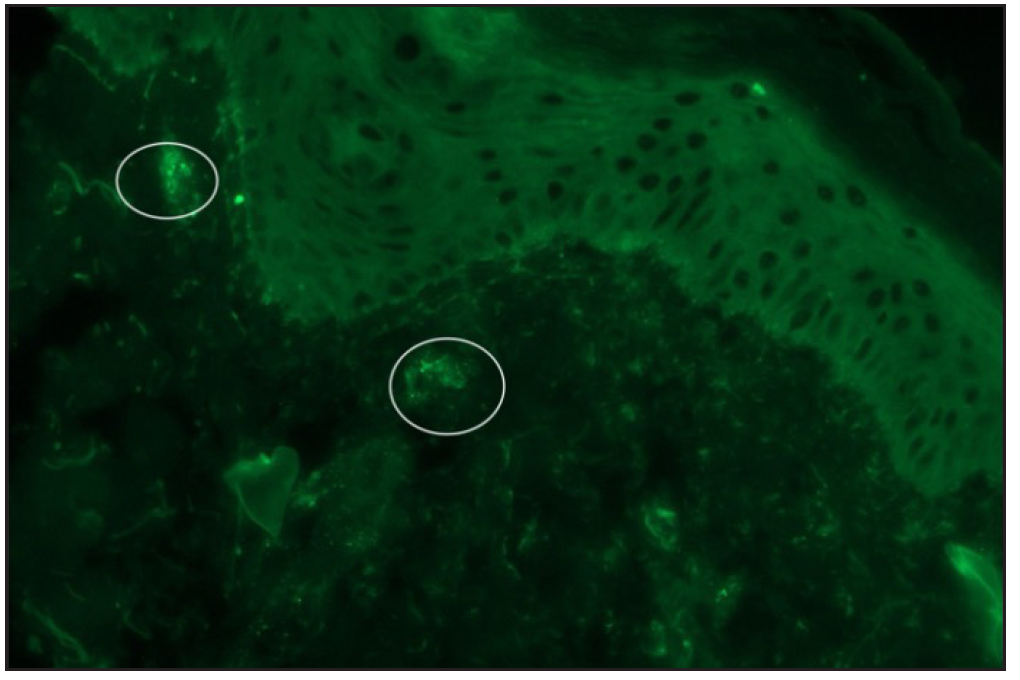 Direct immunofluorescence of skin biopsy of patient 2 showing granular immunoglobulin A deposits around dermal vessels.