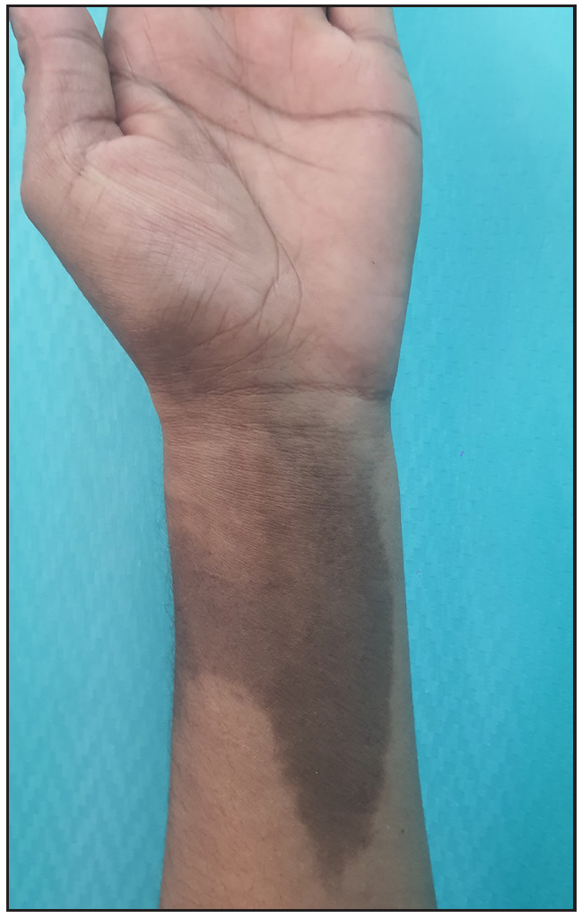 Well-to-ill-defined slate-grey hyperpigmented patch measuring approximately 10 cm × 6 cm, extending from the ventral aspect of the forearm.
