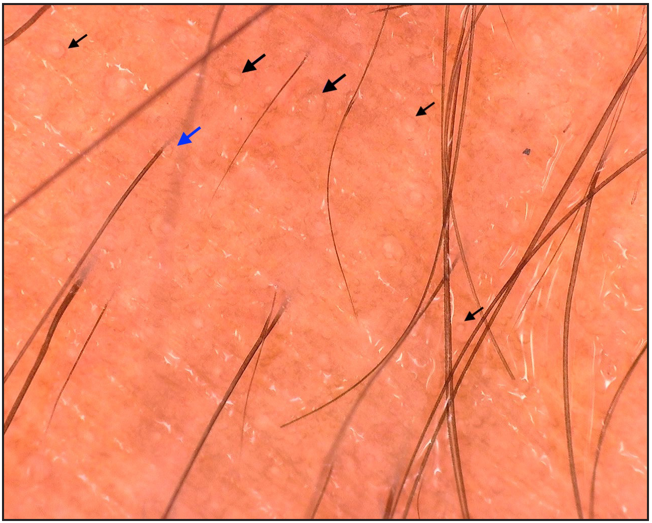 Dermoscopy [AM7115MZT Dino-Lite Edge 3.0 digital microscope] showing perieccrine (black arrows) and perifollicular (blue arrow) brown deposits (Polarised, 35x).