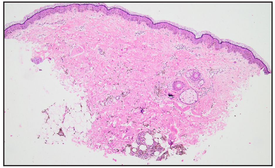 Photomicrograph showing Mild perivascular inflammation in the dermis along with abundant brown pigment throughout the dermis around capillaries and eccrine.glands (Haematoxylin and eosin, 40x).