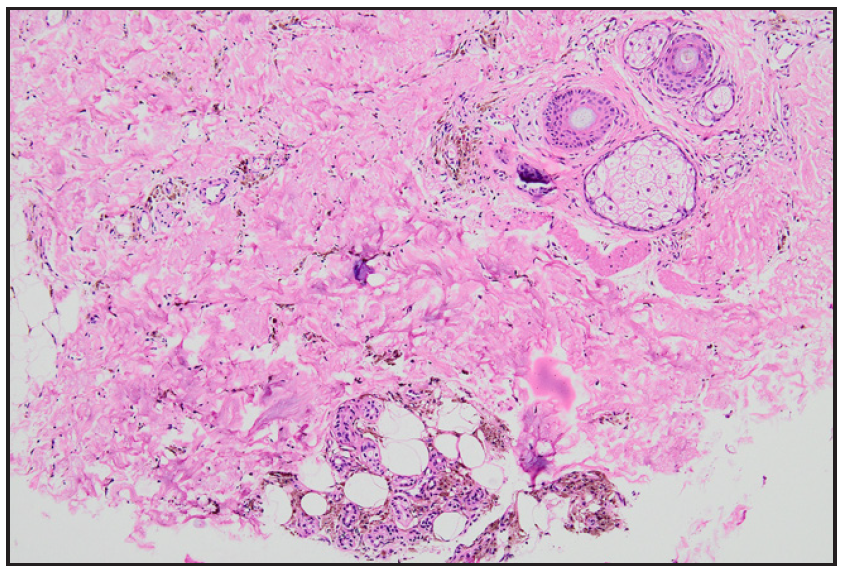 Photomicrograph showing abundant hemosiderin around capillaries and eccrine glands in the dermis (Haematoxylin and eosin, 100x).