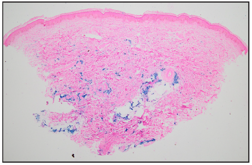 Photomicrograph showing abundant hemosiderin around capillaries and eccrine glands in the dermis (Perl’s stain, 40x).