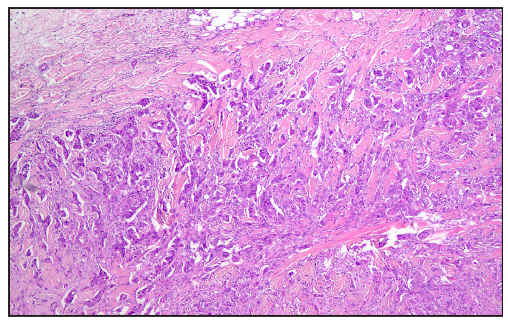 Metastatic poorly differentiated salivary gland adenocarcinoma infiltrating the dermis. A diffuse cellular infiltrate infiltrating into the dermis without obvious epidermal involvement (Haematoxylin & eosin, 100x).