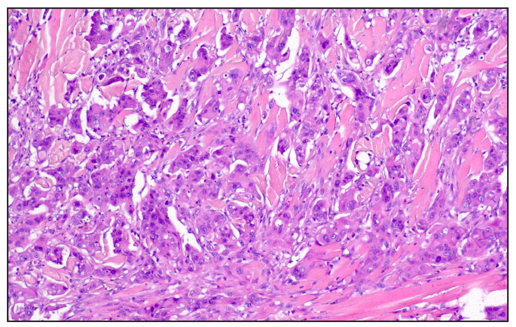 Pleomorphic cells with scattered mitotic activity (Haematoxylin & eosin, 200x).