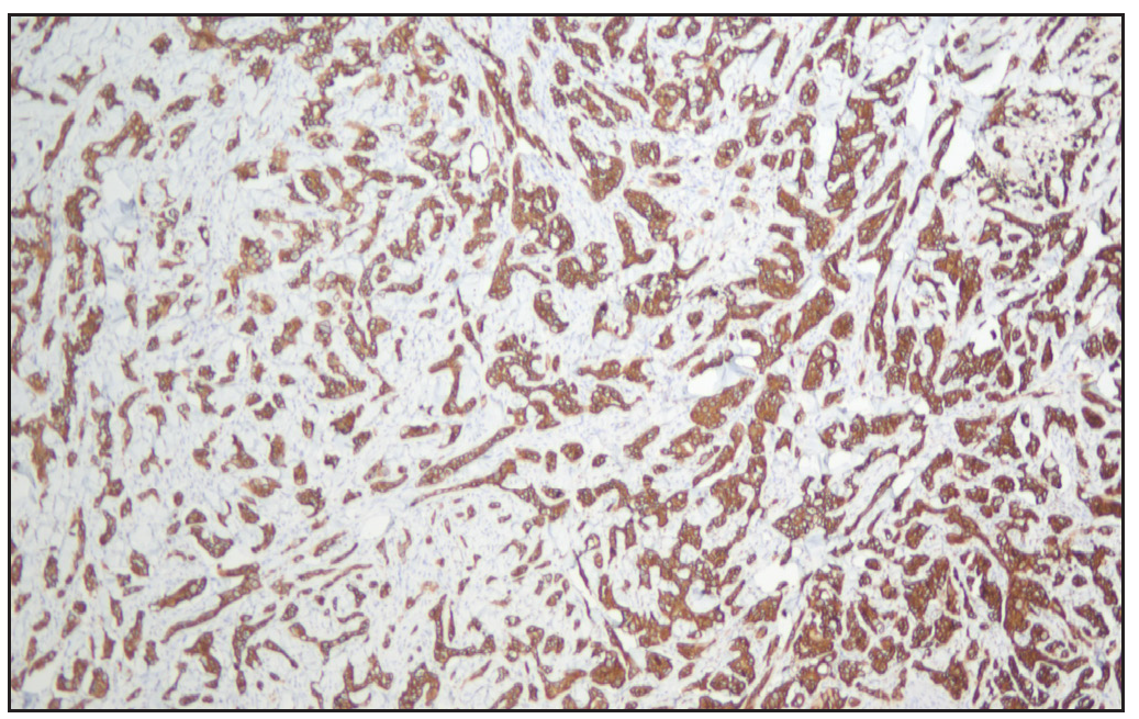 Cytokeratin Antibody Monoclonal (CAM) 5.2 immunohistochemical study highlighted the tumour cells (100x).