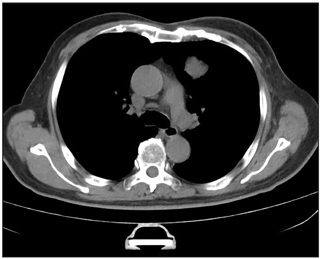 Computed tomography scan image. High-density nodular shadows were seen in the lungs, indicating possible metastatic cancer.