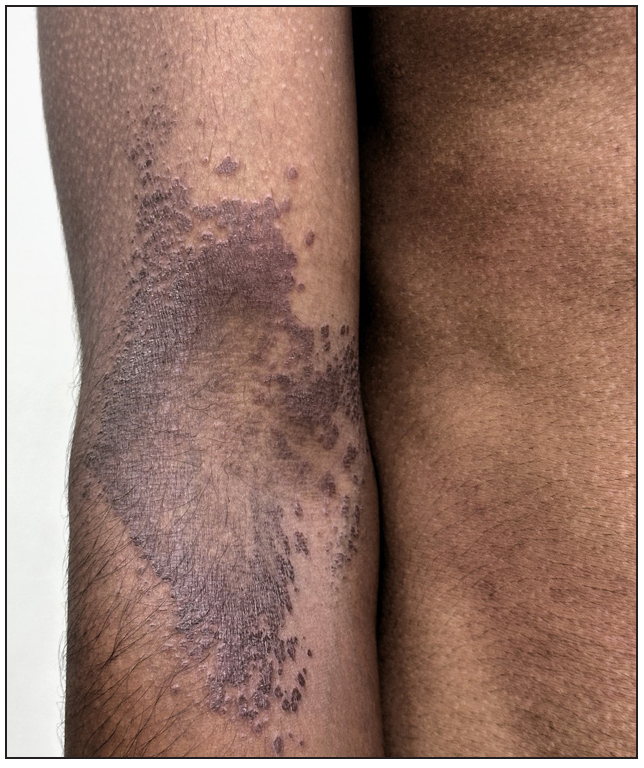 Close-up of the coalescing lesions with raised borders in the left elbow.