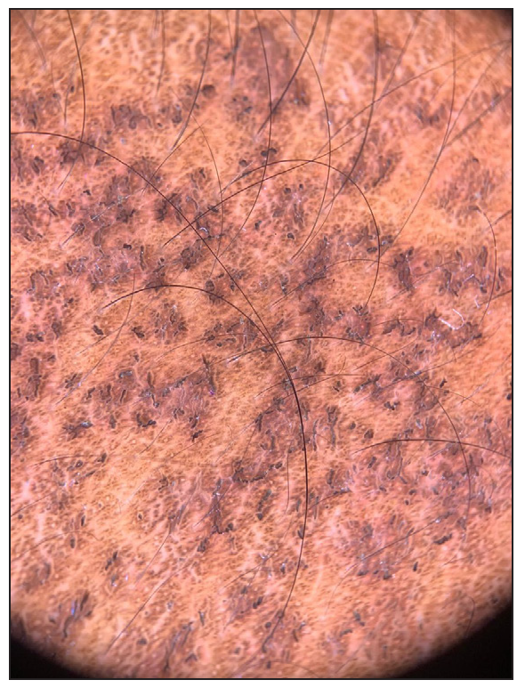 Dermoscopy showing areas of accentuation of pigment network with overlying short brown lines, some angulated (Dermlite DL4, polarised, 10x).