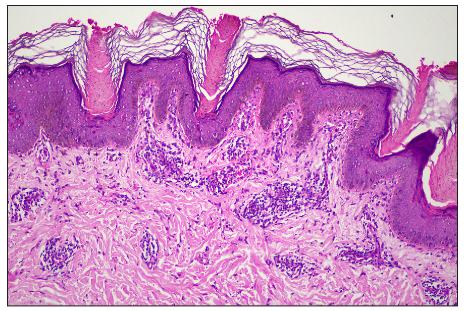 Multiple epidermal invaginations with cornoid lamellae (Haematoxylin & eosin, 100x).