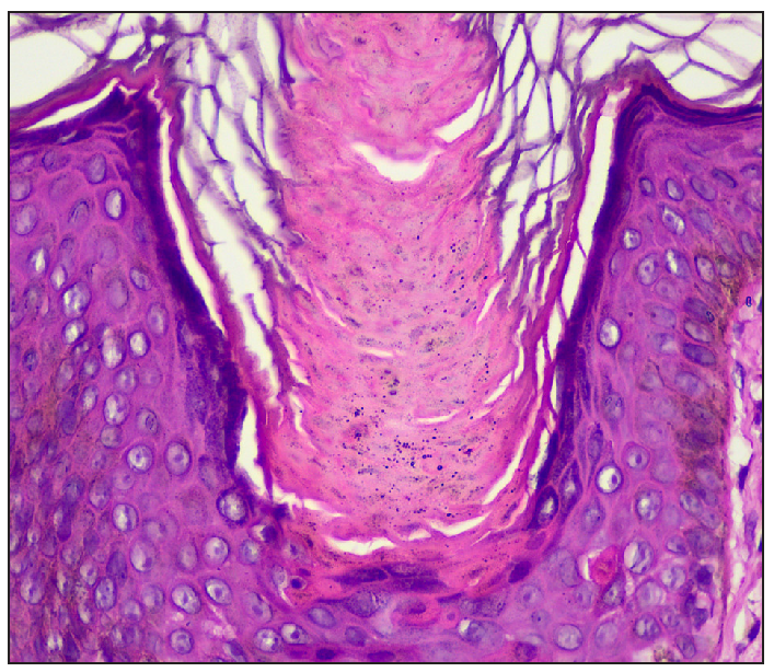Cornoid lamella with underlying dyskeratotic cells (Haematoxylin and eosin, 400x).