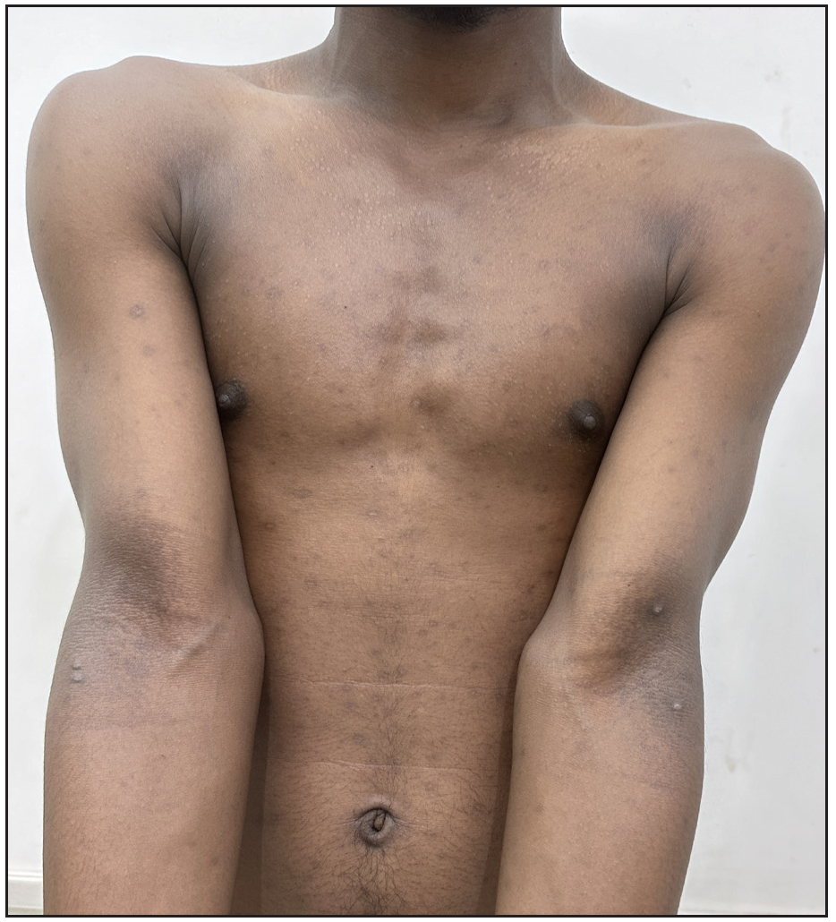 Complete resolution after one month of treatment.