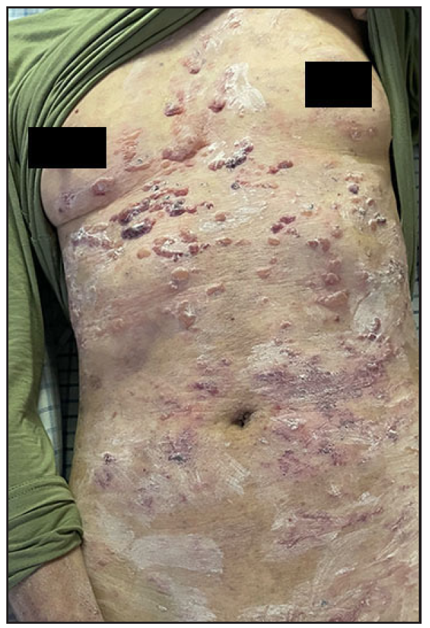 Extensive blisters and erythema on the trunk before treatment in patient 1.
