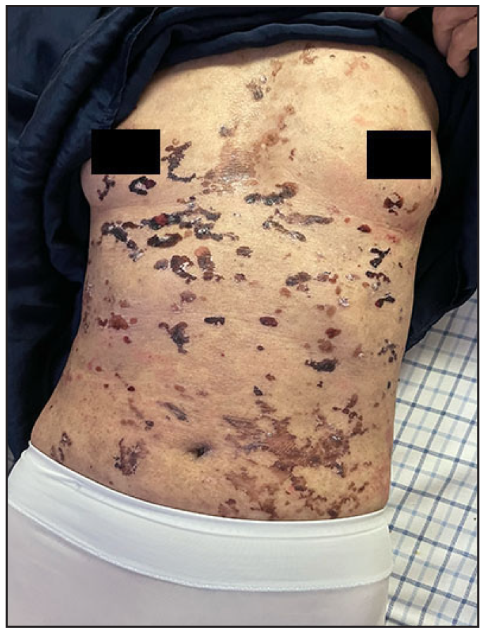 Resolution of blisters and erythema with dupilumab at week 4 in patient 1.