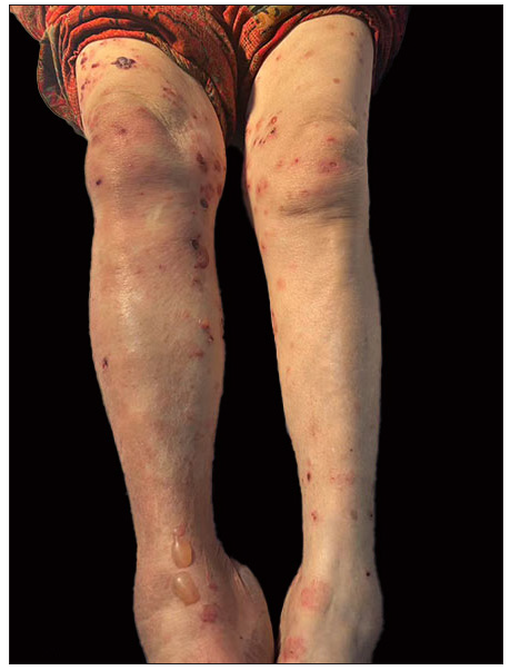 Patient 2: Multiple blisters and erythematous plaques on the lower limbs before treatment in patient 2.