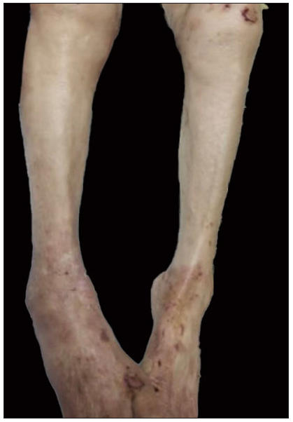 Significant regression of blisters and erythema with dupilumab treatment at week 4.