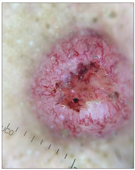 Dermoscopy revealed polymorphic vessels, multiple dilated tortuous, and hairpin vessels arranged peripherally in a radiating fashion with a central keratin plug and pin-point haemorrhages (DermLite™ DL4; polarised mode 10x).