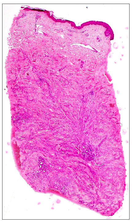 Skin biopsy revealed tumour cells arranged in clusters, nests, and cords in the deep dermis and subcutaneous tissue (Haematoxylin & eosin, 40x).