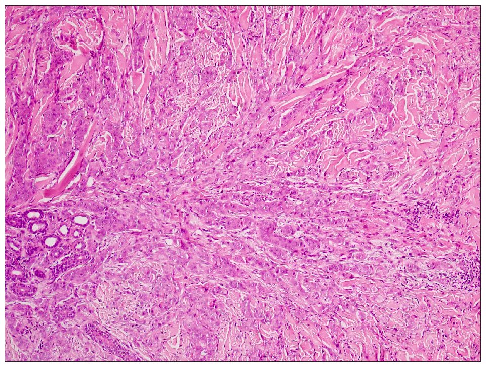 Skin biopsy revealed tumour cells oval to round in shape, having vesicular chromatin, a conspicuous nucleolus, and a scant amount of cytoplasm arranged in clusters, nests, and cords in the deep dermis and subcutaneous tissue (Haematoxylin & eosin, 400x).
