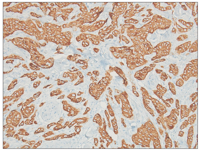 Immunohistochemistry of cells positive for CK7 (100x).