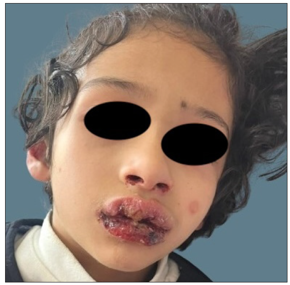 Extensive mucosal involvement in the form of haemorrhagic cheilitis and conjunctivitis in the child of RIME (reactive infectious mucocutaneous eruption).