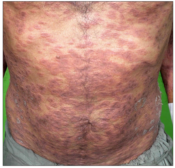 Edematous, erythematous plaques over the abdomen in a patient of VEXAS syndrome.